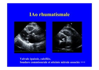 IAo rhumatismale




Valvule épaissie, calcifiée,
Soudure commissurale et atteinte mitrale associée +++
 
