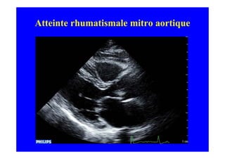 Atteinte rhumatismale mitro aortique
 