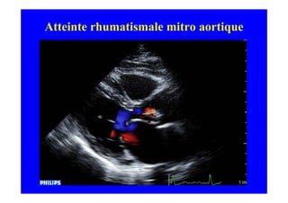 Atteinte rhumatismale mitro aortique
 