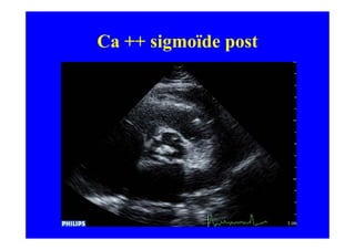 Ca ++ sigmoïde post
 