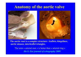 Anatomy of the aortic valve




The aortic root is a complex structure : leaflets, hingelines,
aortic sinuses, interleaflet triangles.
    The term « arterial root » is better than « arterial ring »
             Ho S. Eur journal of echography 2009
 