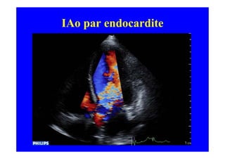 IAo par endocardite
 
