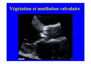Végétation et mutilation valvulaire
 