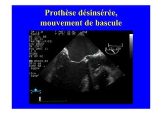 Prothèse désinsérée,
mouvement de bascule
 