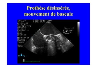 Prothèse désinsérée,
mouvement de bascule
 