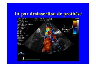 IA par désinsertion de prothèse
 