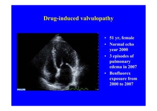 Drug-induced valvulopathy


                     • 51 yr, female
                     • Normal echo
                       year 2000
                     • 3 episodes of
                       pulmonary
                       edema in 2007
                     • Benfluorex
                       exposure from
                       2000 to 2007
 