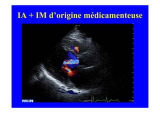 IA + IM d’origine médicamenteuse
 