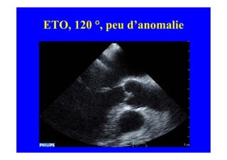 ETO, 120 °, peu d’anomalie
 