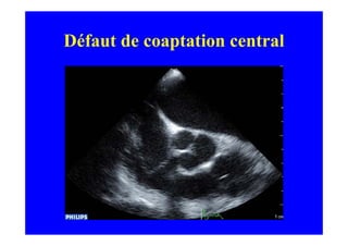 Défaut de coaptation central
 