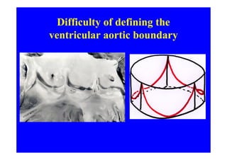 Difficulty of defining the
ventricular aortic boundary
 