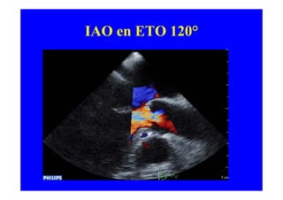 IAO en ETO 120°
 