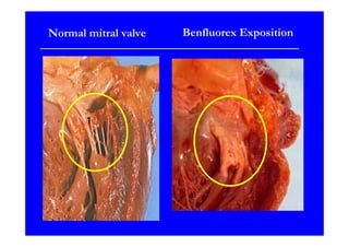 Normal mitral valve   Benfluorex Exposition
 