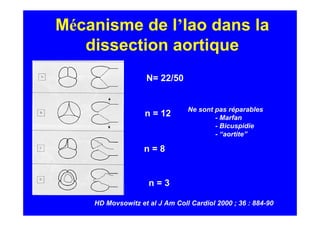 Mécanisme de l’Iao dans la
   dissection aortique
                   N= 22/50


                                Ne sont pas réparables
                   n = 12               - Marfan
                                        - Bicuspidie
                                        - “aortite”

                   n=8


                    n=3

    HD Movsowitz et al J Am Coll Cardiol 2000 ; 36 : 884-90
 
