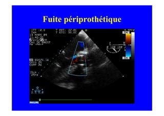 Fuite périprothétique
 