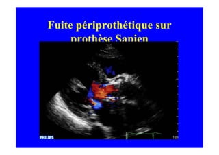 Fuite périprothétique sur
     prothèse Sapien
 