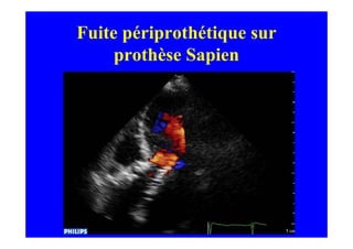 Fuite périprothétique sur
     prothèse Sapien
 