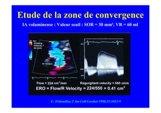 Etude de la zone de convergence
 IA volumineuse : Valeur seuil : SOR = 30 mm², VR = 60 ml




              C. Tribouilloy J Am Coll Cardiol 1998;32:1032-9
 