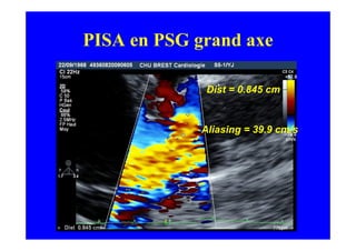 PISA en PSG grand axe

              Dist = 0.845 cm


             Aliasing = 39.9 cm/s
 