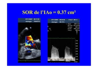 SOR de l’IAo = 0.37 cm²
 