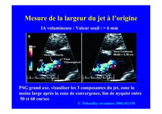 Mesure de la largeur du jet à l’origine
           IA volumineuse : Valeur seuil : > 6 mm




PSG grand axe, visualiser les 3 composantes du jet, zone la
moins large après la zone de convergence, lim de nyquist entre
50 et 60 cm/sec
                             C. Tribouilloy circulation 2000;102:558
 
