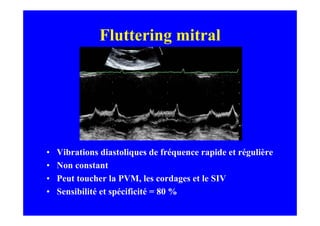 Fluttering mitral




•   Vibrations diastoliques de fréquence rapide et régulière
•   Non constant
•   Peut toucher la PVM, les cordages et le SIV
•   Sensibilité et spécificité = 80 %
 
