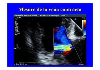 Mesure de la vena contracta
 