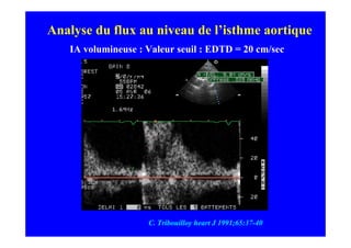 Analyse du flux au niveau de l’isthme aortique
   IA volumineuse : Valeur seuil : EDTD = 20 cm/sec




                    C. Tribouilloy heart J 1991;65:37-40
 