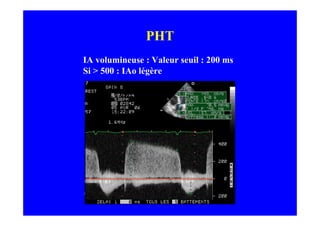 PHT
IA volumineuse : Valeur seuil : 200 ms
Si > 500 : IAo légère
 
