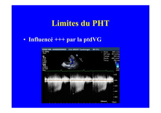 Limites du PHT
• Influencé +++ par la ptdVG
 
