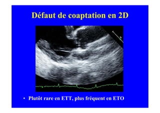 Défaut de coaptation en 2D




• Plutôt rare en ETT, plus fréquent en ETO
 