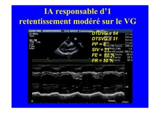 IA responsable d’1
retentissement modéré sur le VG
                   DTDVG = 64
                   DTSVG = 31
                   PP = 8
                   SIV = 11
                   FE = 82 %
                   FR = 52 %
 