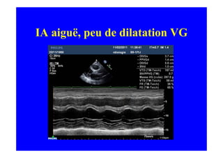 IA aiguë, peu de dilatation VG
 