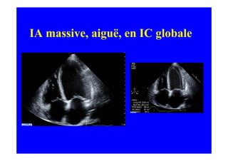 IA massive, aiguë, en IC globale
 