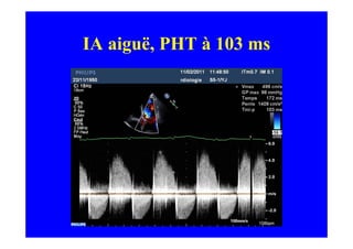IA aiguë, PHT à 103 ms
 