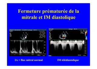 Fermeture prématurée de la
   mitrale et IM diastolique




IA + flux mitral normal   IM télédiastolique
 