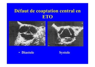 Défaut de coaptation central en
             ETO




 • Diastole         Systole
 