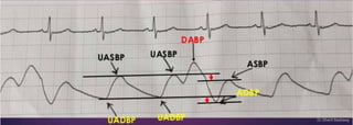 Intraaortic Baloon Counter Pulsation
Dr.Sherif Badrawy
 
