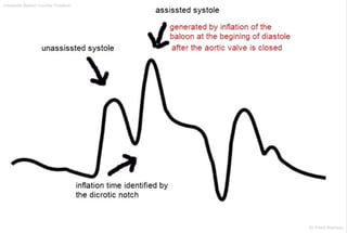 Intraaortic Baloon Counter Pulsation
Dr.Sherif Badrawy
 