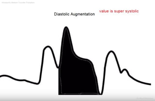 Intraaortic Baloon Counter Pulsation
Dr.Sherif Badrawy
 