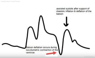 Intraaortic Baloon Counter Pulsation
Dr.Sherif Badrawy
 