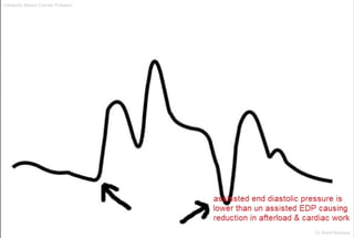 Intraaortic Baloon Counter Pulsation
Dr.Sherif Badrawy
 