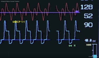 Intraaortic Baloon Counter Pulsation
Dr.Sherif Badrawy
 