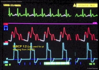Intraaortic Baloon Counter Pulsation
Dr.Sherif Badrawy
 