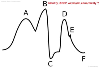 Intraaortic Baloon Counter Pulsation
Dr.Sherif Badrawy
 