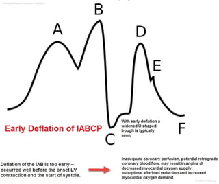 Intraaortic Baloon Counter Pulsation
Dr.Sherif Badrawy
 
