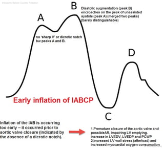 Intraaortic Baloon Counter Pulsation
Dr.Sherif Badrawy
 