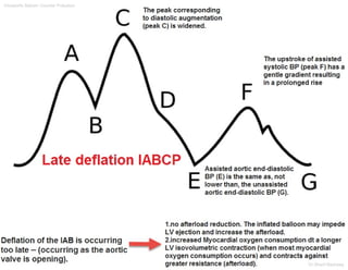 Intraaortic Baloon Counter Pulsation
Dr.Sherif Badrawy
 