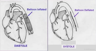 Intraaortic Baloon Counter Pulsation
Dr.Sherif Badrawy
 