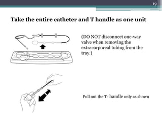 19
Take the entire catheter and T handle as one unit
(DO NOT disconnect one-way
valve when removing the
extracorporeal tubing from the
tray.)
Pull out the T- handle only as shown
 